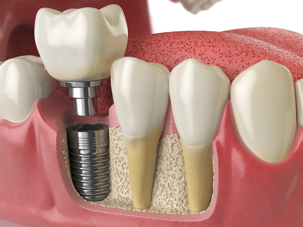 implante dental - hispano dental