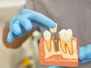 Periimplantitis: ¿Qué es y cómo tratarla?